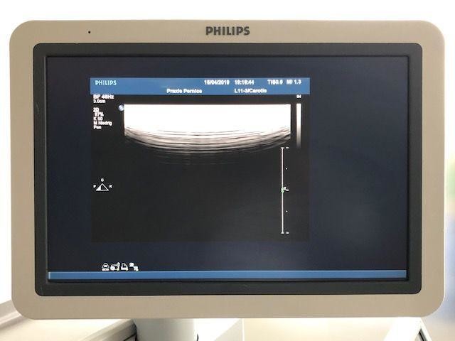 Latest company case about Philips IE33 ultrasonic diagnostic instrument common fault troubleshooting（2）